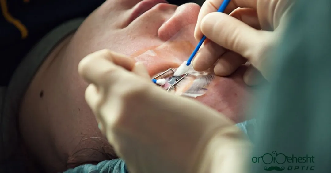 همه چیز درباره عمل چشم همه چیز درباره عمل چشم