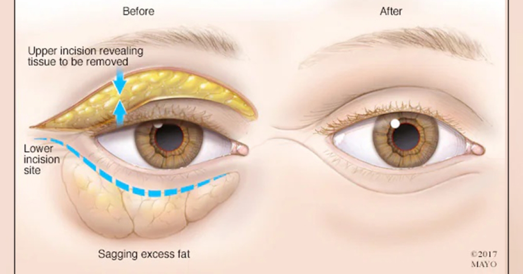 عمل پلک بلفار پلاستی عمل پلک بلفار پلاستی