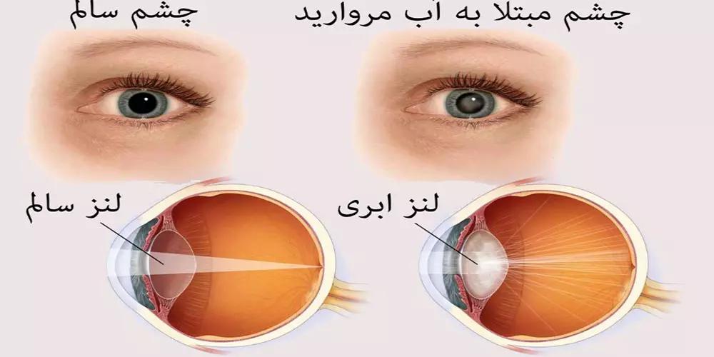 هر چه باید درباره آب مروارید بدانید + نکات مهم برای جلوگیری