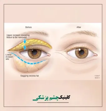 بلفاروپلاستی | عمل جراحی پلک و رفع افتادگی چشم