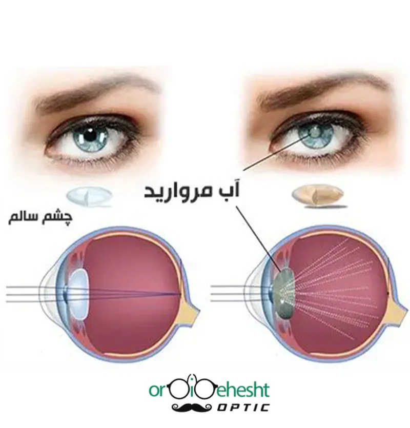 ✔️عمل آب مروارید